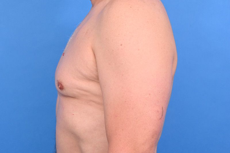 Gynecomastia Surgery Before & After Image