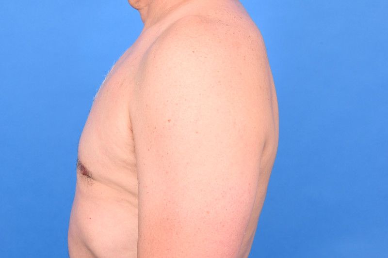 Gynecomastia Surgery Before & After Image