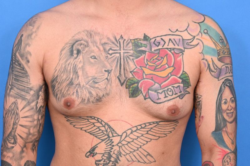 Gynecomastia Surgery Before & After Image