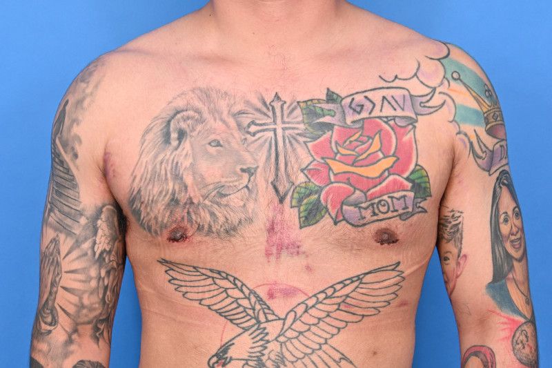 Gynecomastia Surgery Before & After Image