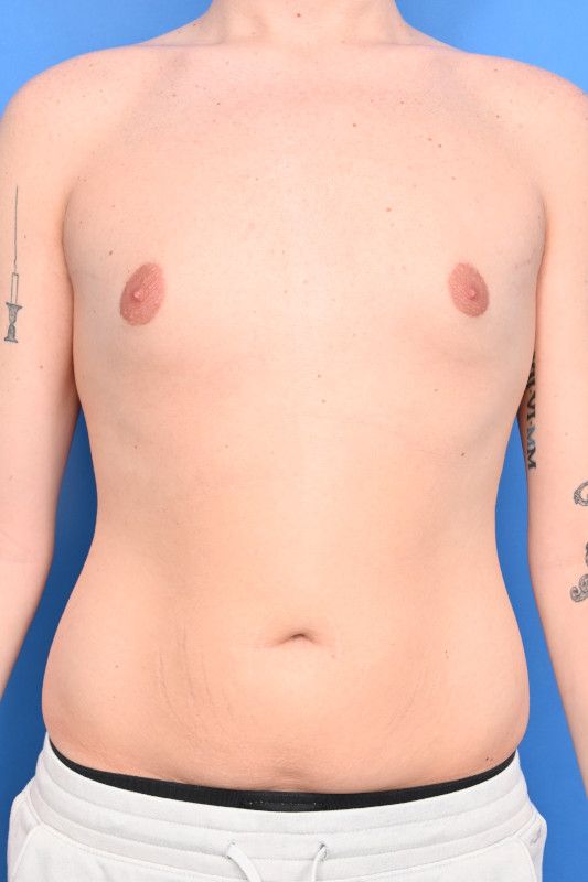 Gynecomastia Surgery Before & After Image