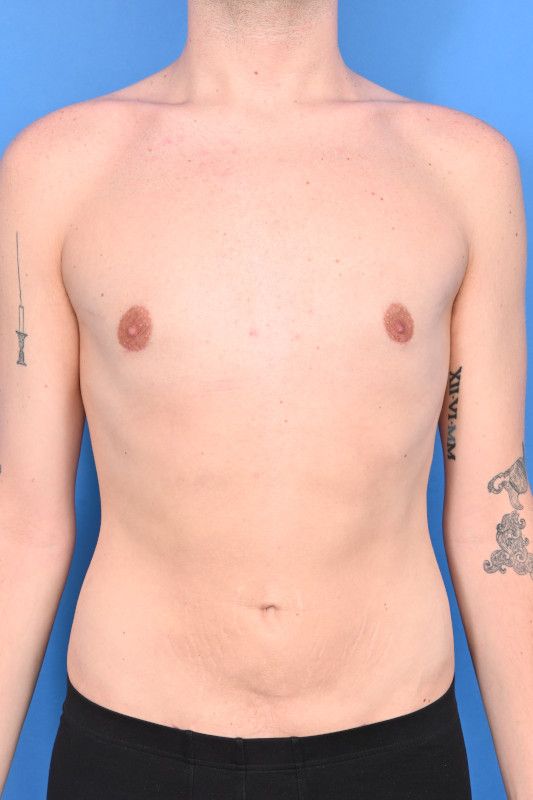Gynecomastia Surgery Before & After Image