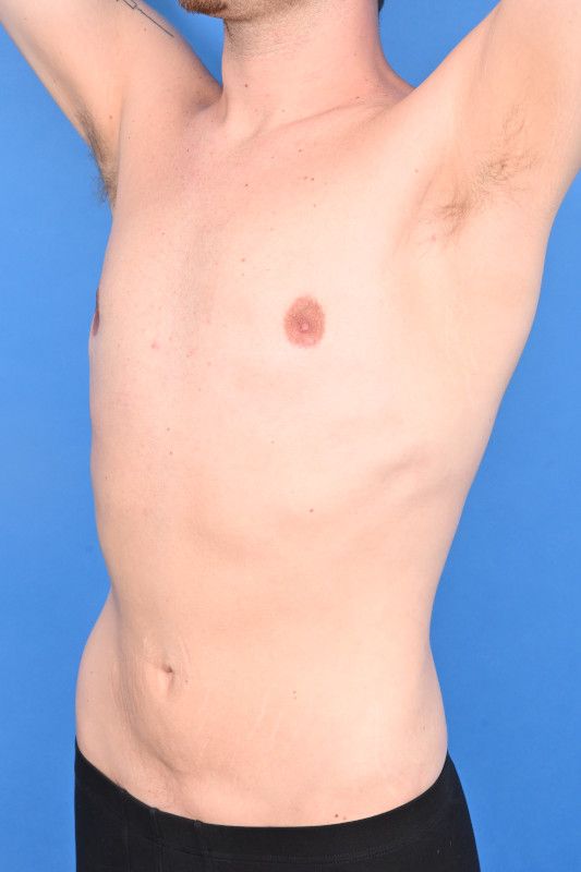 Gynecomastia Surgery Before & After Image