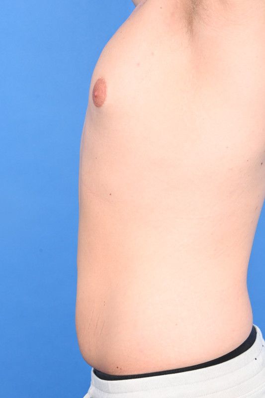 Gynecomastia Surgery Before & After Image