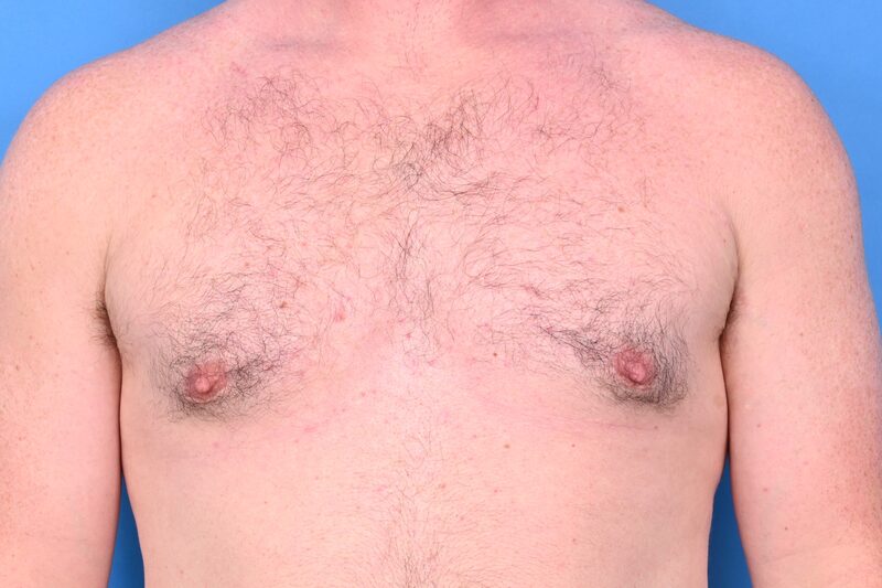 Gynecomastia Surgery Before & After Image