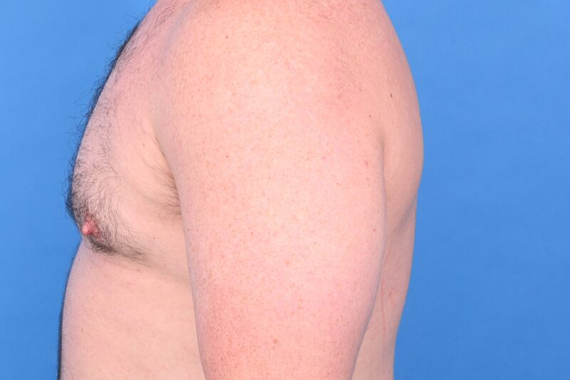 Gynecomastia Surgery Before & After Image