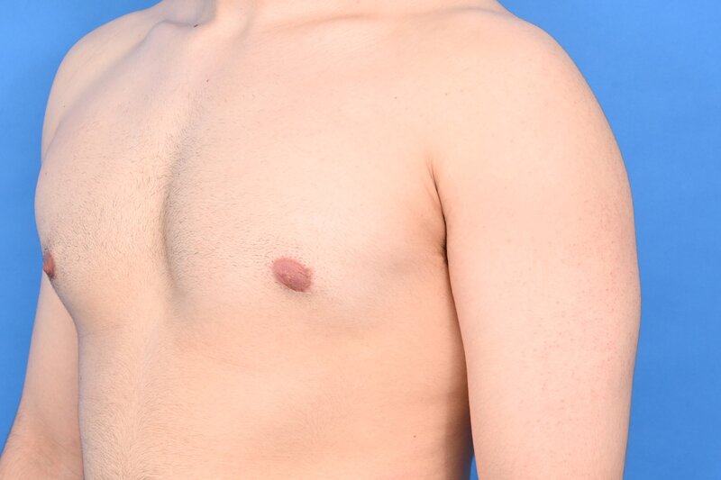 Gynecomastia Surgery Before & After Image
