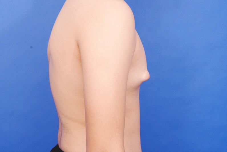 Gynecomastia Surgery Before & After Image