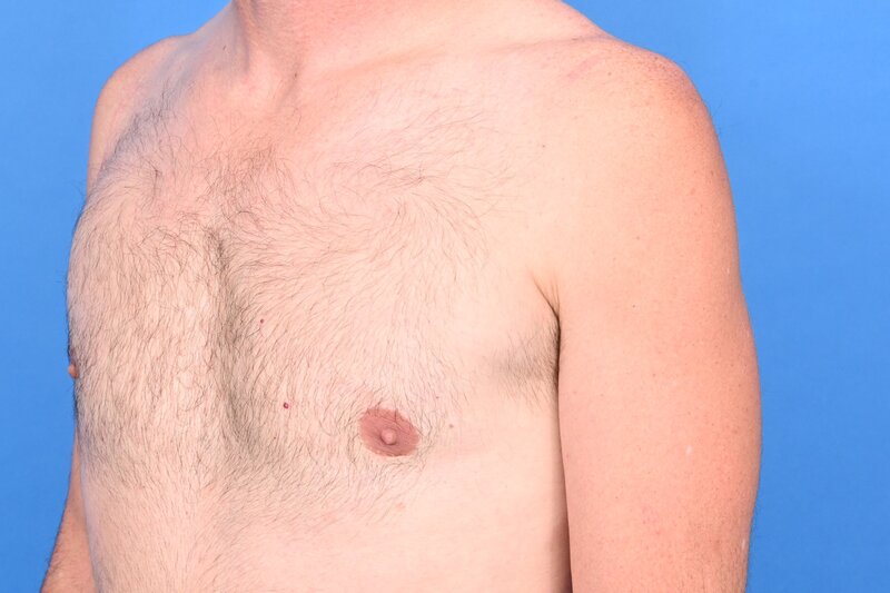 Gynecomastia Surgery Before & After Image