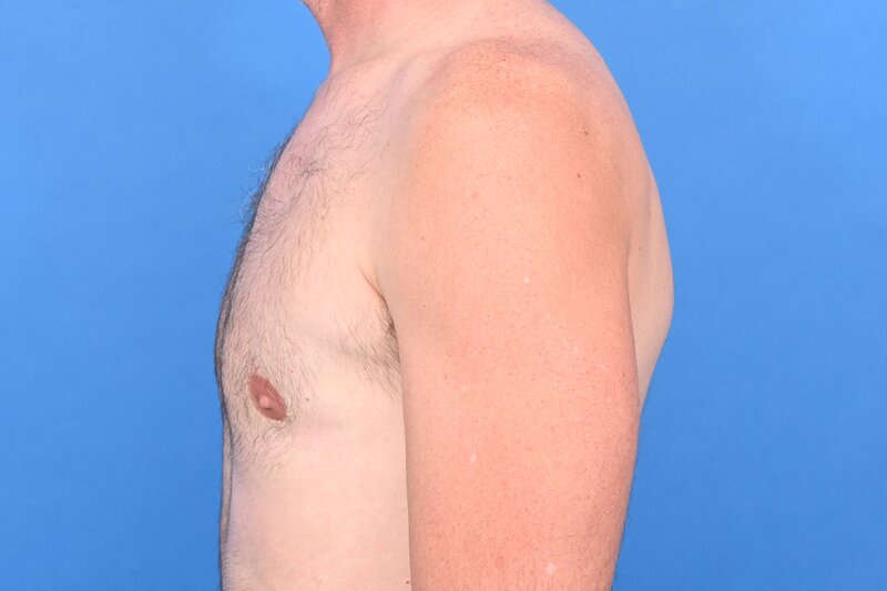 Gynecomastia Surgery Before & After Image