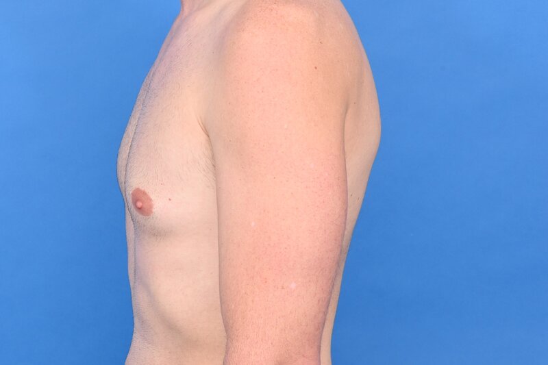 Gynecomastia Surgery Before & After Image