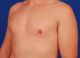 Revision Gynecomastia Surgery Before & After Image