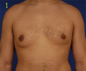 Revision Gynecomastia Surgery Before & After Image