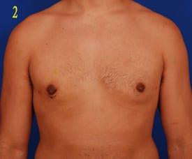 Revision Gynecomastia Surgery Before & After Image