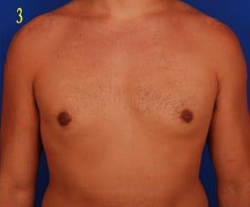 Revision Gynecomastia Surgery Before & After Image