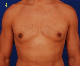 Revision Gynecomastia Surgery Before & After Image