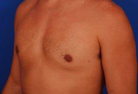 Revision Gynecomastia Surgery Before & After Image