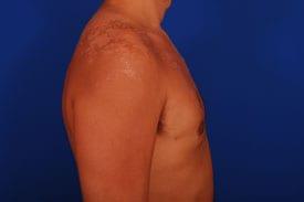 Revision Gynecomastia Surgery Before & After Image