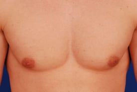 Revision Gynecomastia Surgery Before & After Image
