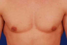 Revision Gynecomastia Surgery Before & After Image