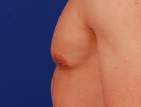 Revision Gynecomastia Surgery Before & After Image