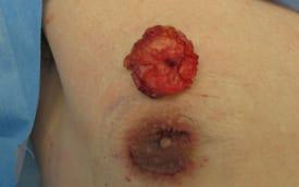 Revision Gynecomastia Surgery Before & After Image