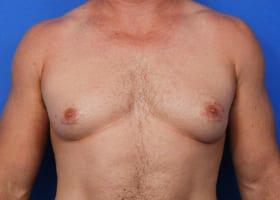 Revision Gynecomastia Surgery Before & After Image