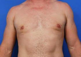 Revision Gynecomastia Surgery Before & After Image