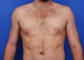 Revision Gynecomastia Surgery Before & After Image