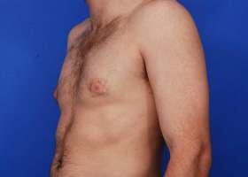 Revision Gynecomastia Surgery Before & After Image
