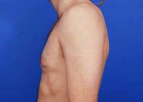 Revision Gynecomastia Surgery Before & After Image