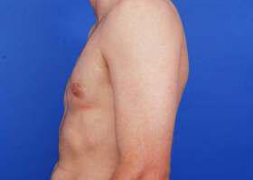 Revision Gynecomastia Surgery Before & After Image