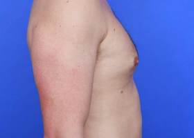 Revision Gynecomastia Surgery Before & After Image
