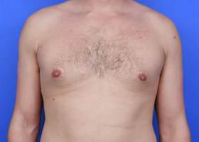 Revision Gynecomastia Surgery Before & After Image