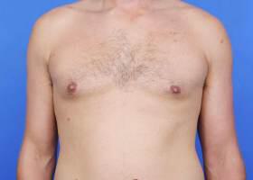Revision Gynecomastia Surgery Before & After Image
