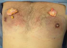 Revision Gynecomastia Surgery Before & After Image