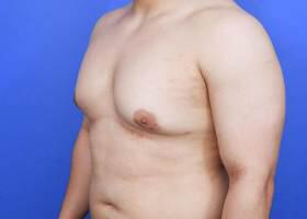 Revision Gynecomastia Surgery Before & After Image
