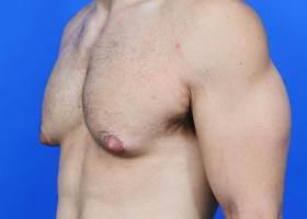 Revision Gynecomastia Surgery Before & After Image