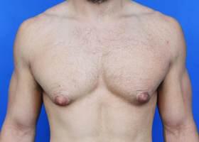 Revision Gynecomastia Surgery Before & After Image