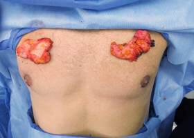Revision Gynecomastia Surgery Before & After Image