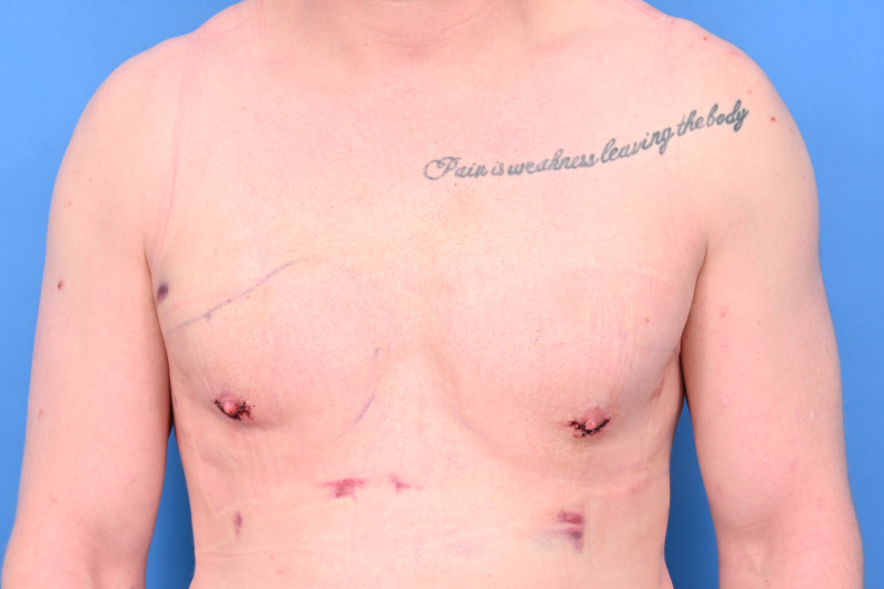 Revision Gynecomastia Surgery Before & After Image