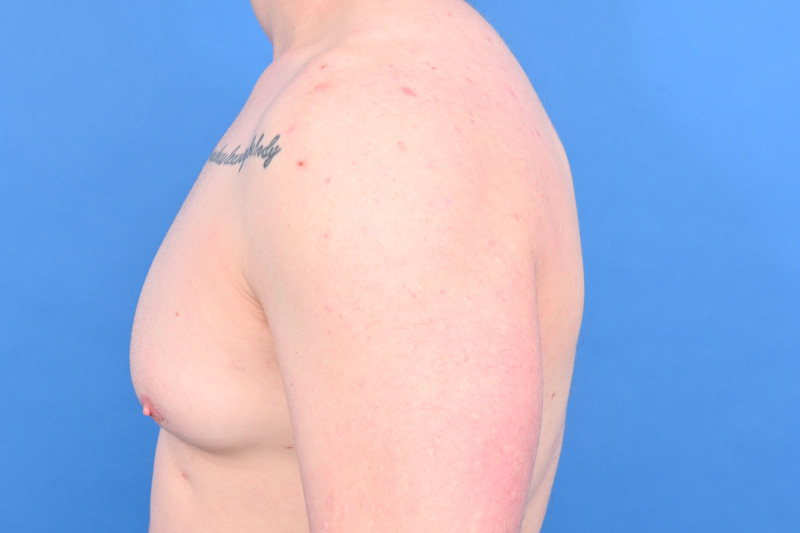 Revision Gynecomastia Surgery Before & After Image