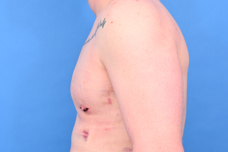 Revision Gynecomastia Surgery Before & After Image